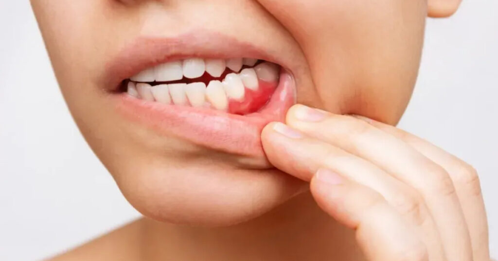 what are the signs and symptoms of gum disease